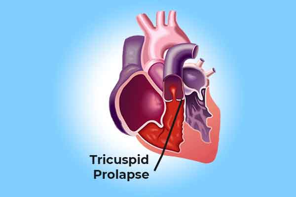 tricuspid prolapse