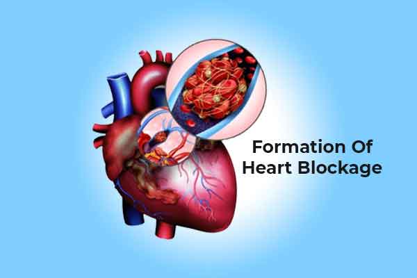 FORMATION OF HEART BLOCKAGE
