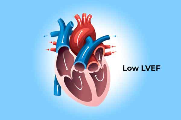 LOW EJECTION FRACTION