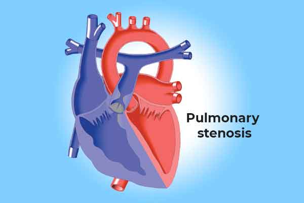 Pulmonary Stenosis Treatment for Heart | Best Ayurvedic Doctor for ...
